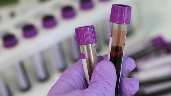 Νέα εξέταση αίματος ανιχνεύει τρεις τύπους καρκίνου μέσα σε λίγα λεπτά