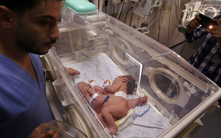 Σαουδική Αραβία: Επιτυχής Διαχωρισμός των Τζαμαϊκανών Διδύμων Αζάρια και Αζούρα Έλσον